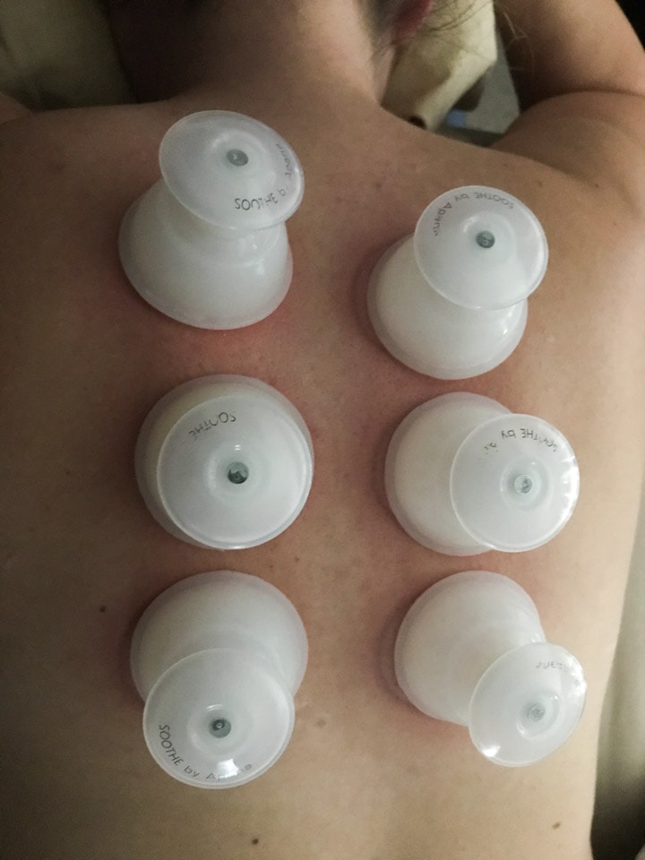Six cupping devices placed on a back